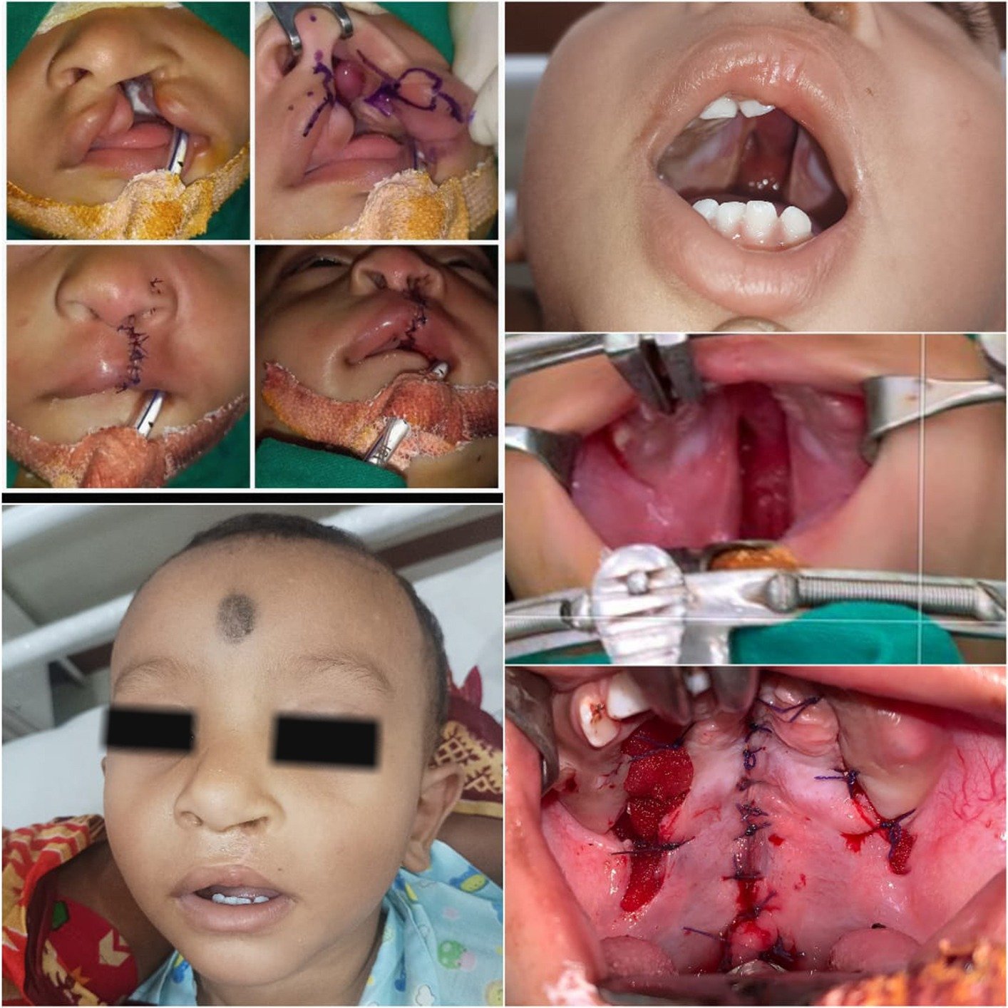 same pt cleft lip and cleft palate before and after